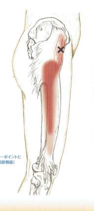 大腿筋膜脹筋