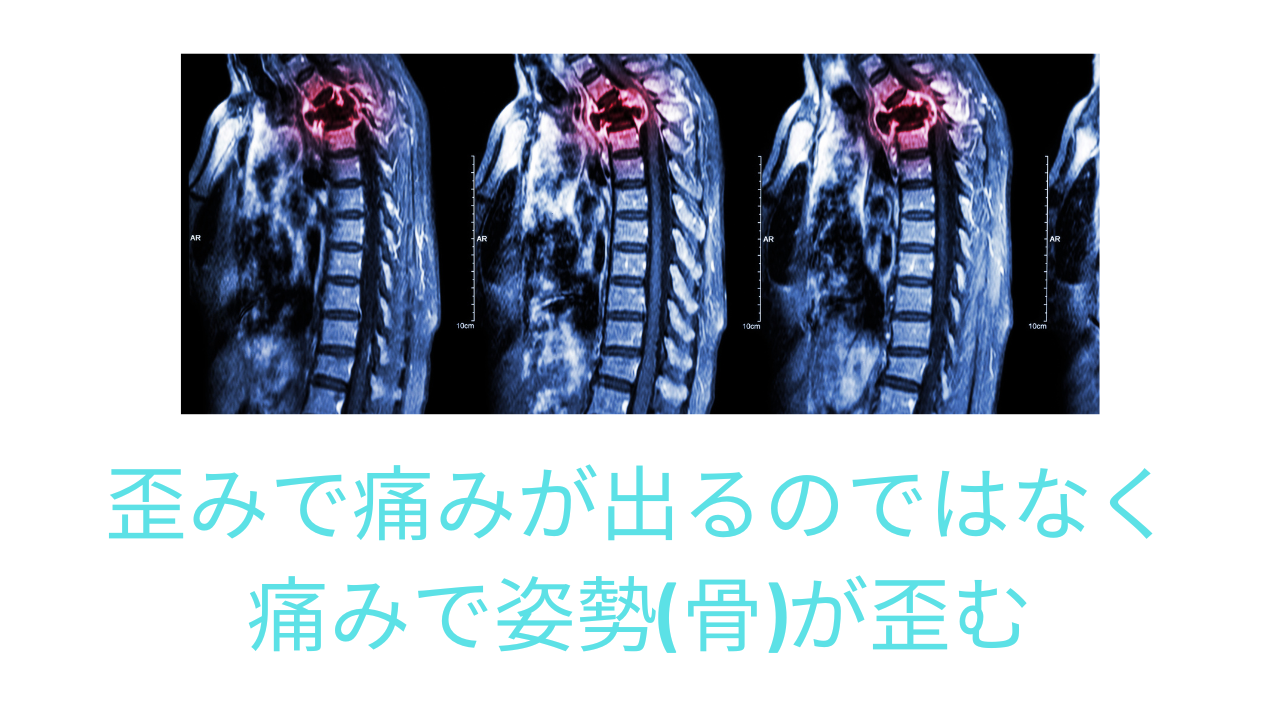 脊椎腫瘍